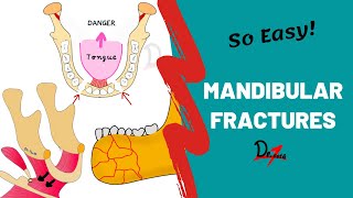 Mandibular Fractures  Basics  DENTAL NOTES [upl. by Ellered]