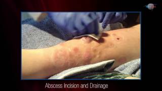 WCW Abscess Incision and Drainage [upl. by Hadria]