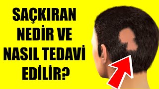 SAÇKIRAN NEDİR VE NASIL TEDAVİ EDİLİR [upl. by Tinaret]