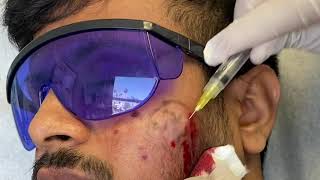 Subcision for Acne Scars [upl. by Adnylem]