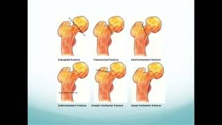 Hip Fractures The basics [upl. by Arin369]