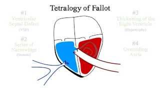 Tetralogy of Fallot [upl. by Ydnirb]