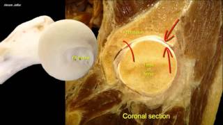 Pelvic Fractures  Everything You Need To Know  Dr Nabil Ebraheim [upl. by Nemsaj90]