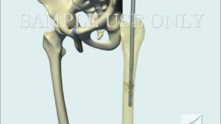 Femoral Fracture Fixation Surgery Intramedullary Nail [upl. by Ennayt]