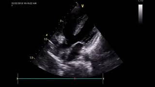 Tetralogy of Fallot TOF [upl. by Oihsoy80]