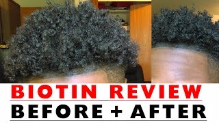 BIOTIN Hair Growth Results Before and After [upl. by Finnie]