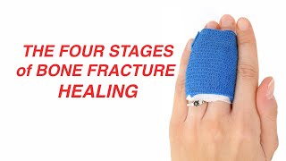 Fracture Healing  Everything You Need To Know  Dr Nabil Ebraheim [upl. by Kroll566]