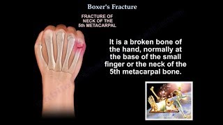 Boxers Fracture  Everything You Need To Know  Dr Nabil Ebraheim [upl. by Casavant]